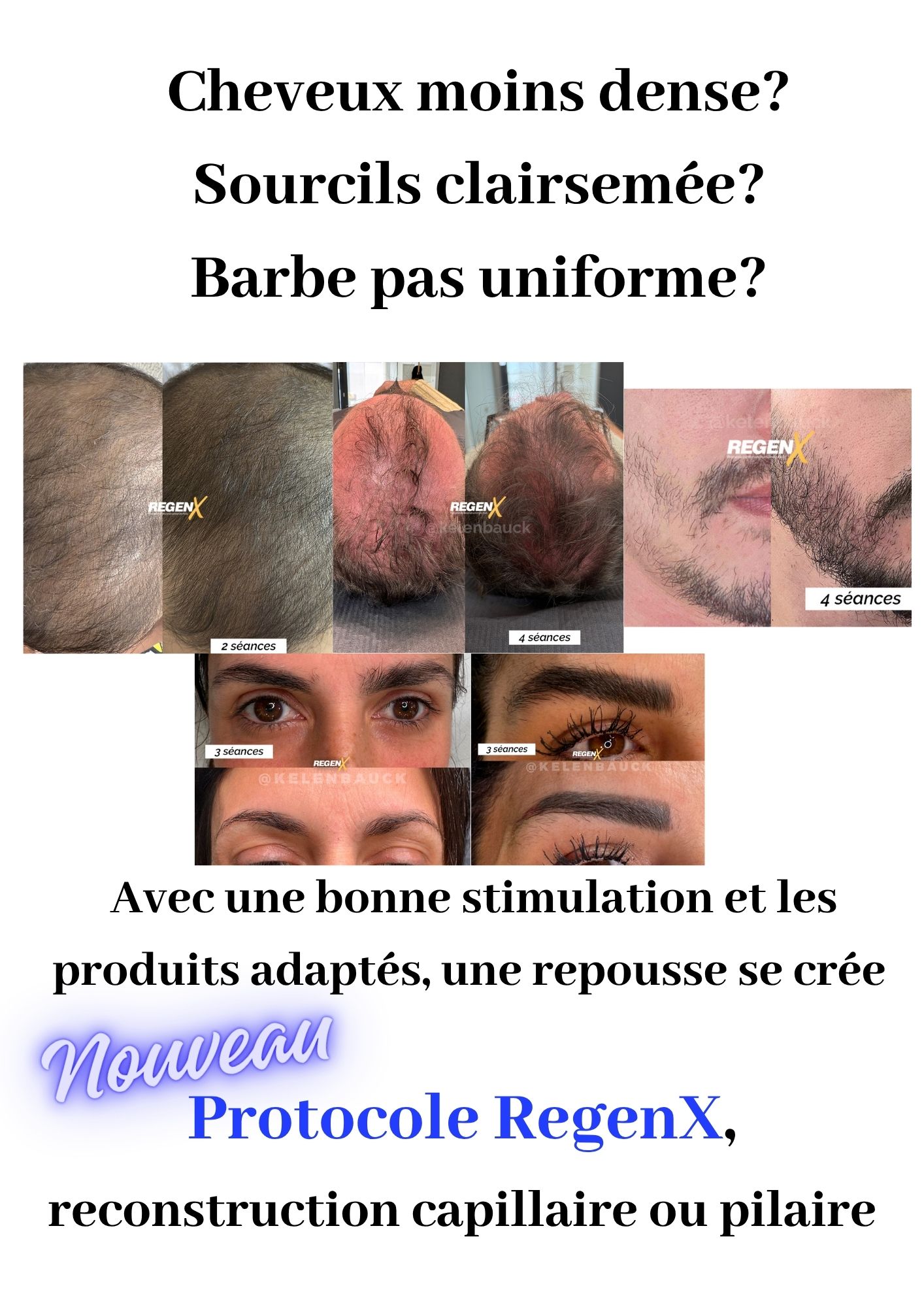 reconstruction capillaire et pilaire regenX